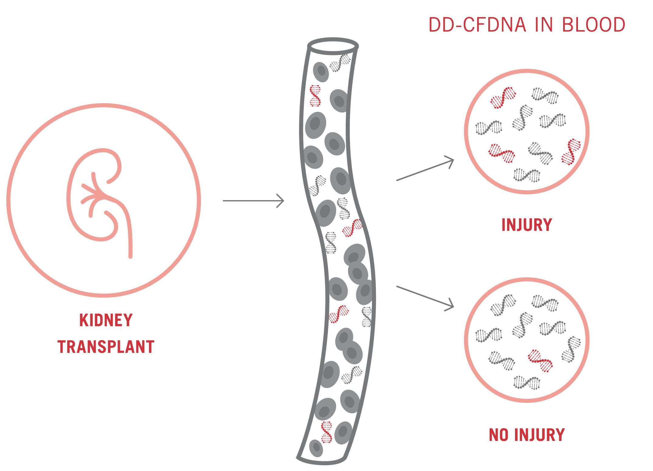 Following a kidney transplant, a higher percentage of dd-cfDNA in blood in indicates injury, whereas a low percentage indicates no injury.